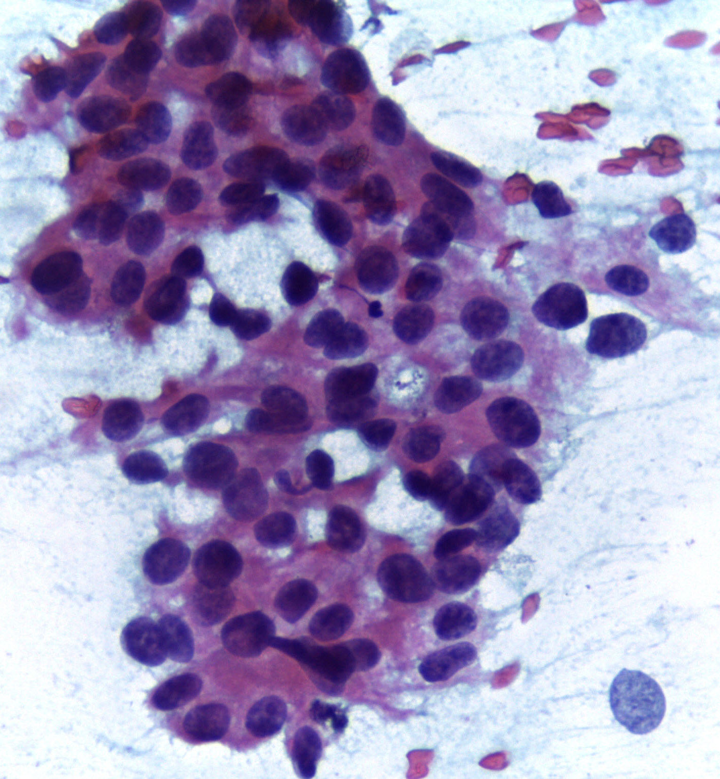 https://upload.wikimedia.org/wikipedia/commons/f/f8/Cytopathology_of_infiltrating_duct_carcinoma_breast_400x.jpg